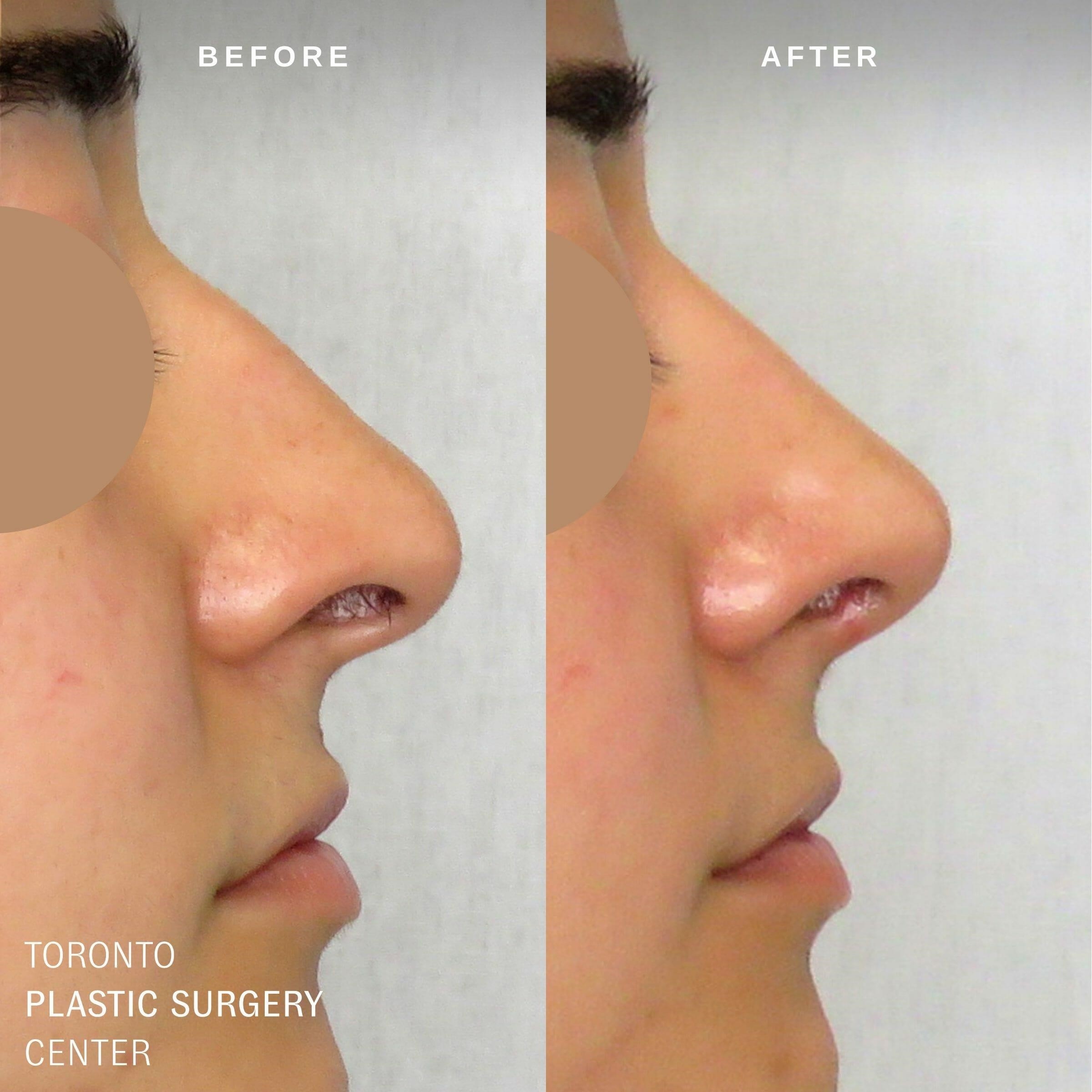 open vs closed rhinoplasty