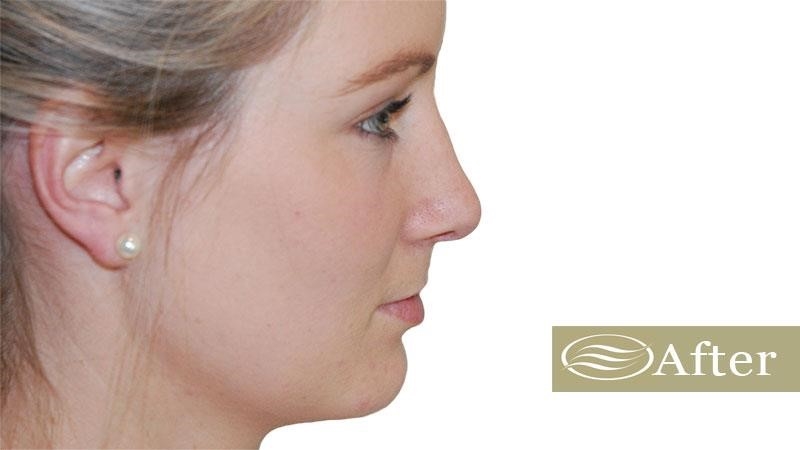 closed rhinoplasty near me