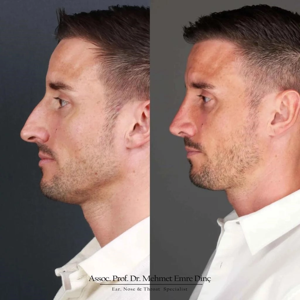 open vs closed rhinoplasty